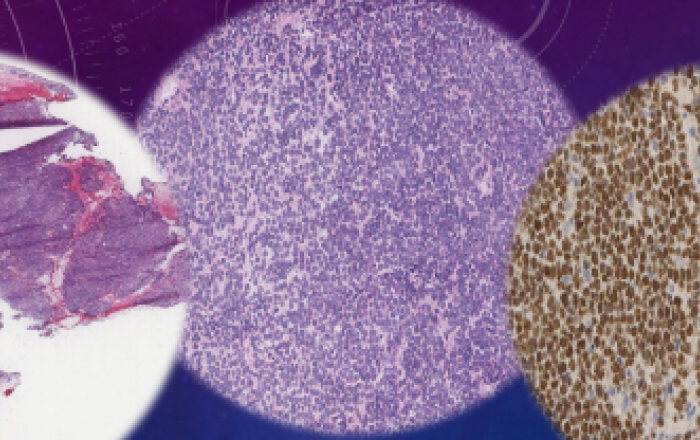 La biopsia mediastinica: dall’estemporanea alla diagnosi definitiva